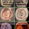 3D Ultrasound in prenatal diagnosis by Rabih Chaoui 2nd edition original PDF 2024