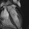 MRIOnline Mastery Series: Cardiac MRI of Non-Ischemic Cardiomyopathy 2021