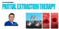 Partial Extraction Therapy Course