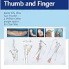 Reconstruction of the Thumb and Finger (Original PDF from Publisher)