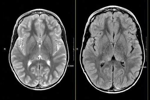 MRIOnline Mastery Series: Neurofibromatosis Type 1 (NF1) 2021