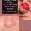 Combination Facial Reconstruction after Mohs Surgery ( pdf )