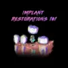Implant Restorations 101 – Implant Ninja