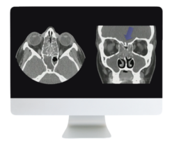 ARRS Cranial Nerve Imaging: From the Least to the Last 2022 ( Videos + CME Questions)