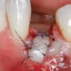 Gidedental Soft Tissue Management around Natural Teeth and Dental Implants 2020