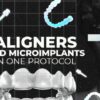 OHI-S Aligners And Microimplants In One Protocol