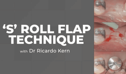 The S Roll Flap Technique
