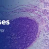 The Pathology of Neoplastic Diseases 2025 (Videos with subtitles + Slides)