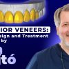 OHI-S Anterior Veneers Smile Design and Treatment Planning by Jan Hajtó