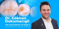 OHI-S Art and science of class 2 composite restorations