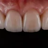 OHI-S Ceramic Veneers Interdisciplinary Approach and Updated Protocols
