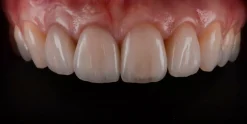 OHI-S Ceramic Veneers Interdisciplinary Approach and Updated Protocols