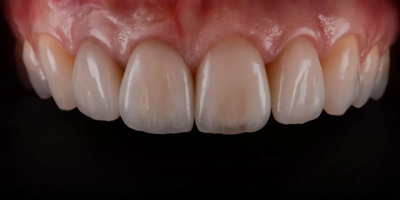 OHI-S Ceramic Veneers Interdisciplinary Approach and Updated Protocols
