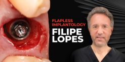 OHI-S Flapless implantology protocols for immediate implant placement and loading