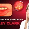 OHI-S Library of Oral Pathology Management of Precancerous and Cancerous Oral Lesions