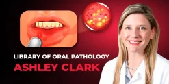OHI-S Library of Oral Pathology Management of Precancerous and Cancerous Oral Lesions