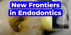 OHI-S New Frontiers in Endodontics Guide to Predictable Practice